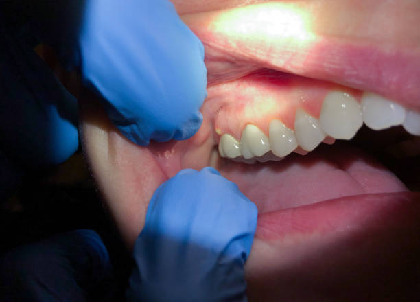 Best Emergency Treatment for Toothache in North Hornell, NY